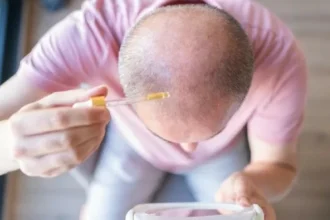 باحثون يتوصلون إلى أول علاج للصلع منذ أكثر من 30 عاماً