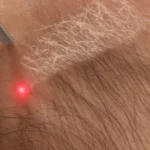 أضرار تشقير الحواجب بالليزر وفق خبراء الجلدية