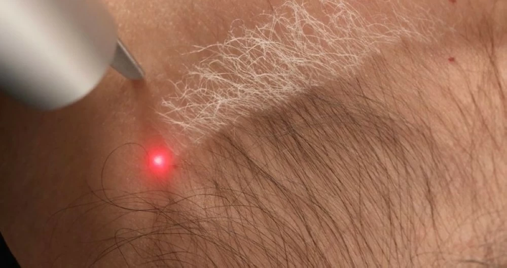 أضرار تشقير الحواجب بالليزر وفق خبراء الجلدية