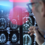 دواء لألزهايمر يحقق نتائج مذهلة في تأخيره 8 سنوات