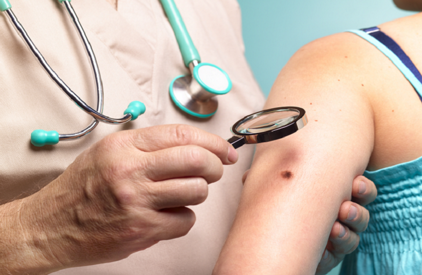 متى تصبح الشامة مقلقة؟ متى تصبح الشامة مقلقة؟