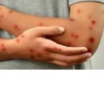 ارتفاع إصابات «جدري القرود» في مدغشقر.. ولا وفيات