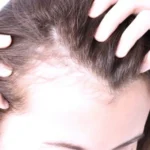 تساقط شعر النساء.. يتجاوز الجانب التجميلي