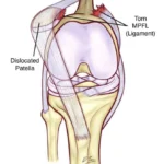 الشهراني يكشف تفاصيل إصابة اللاعب حمد اليامي