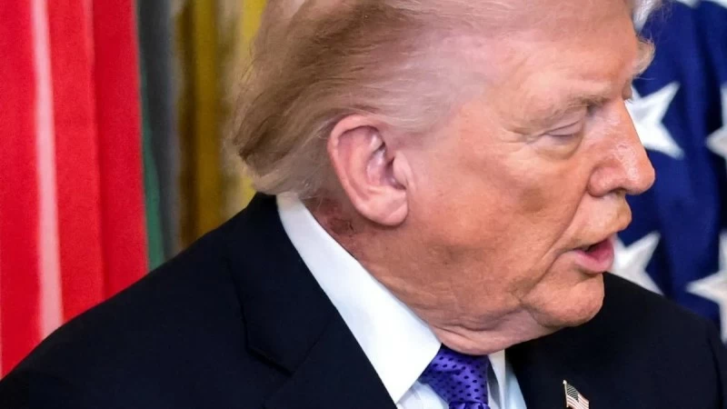 طفح رقبته يثير الجدل.. وطبيب ترمب يوضح: مجرد كريم شائع