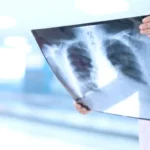 آلية جديدة تفتح باب علاج أكثر فاعلية لمرض السل