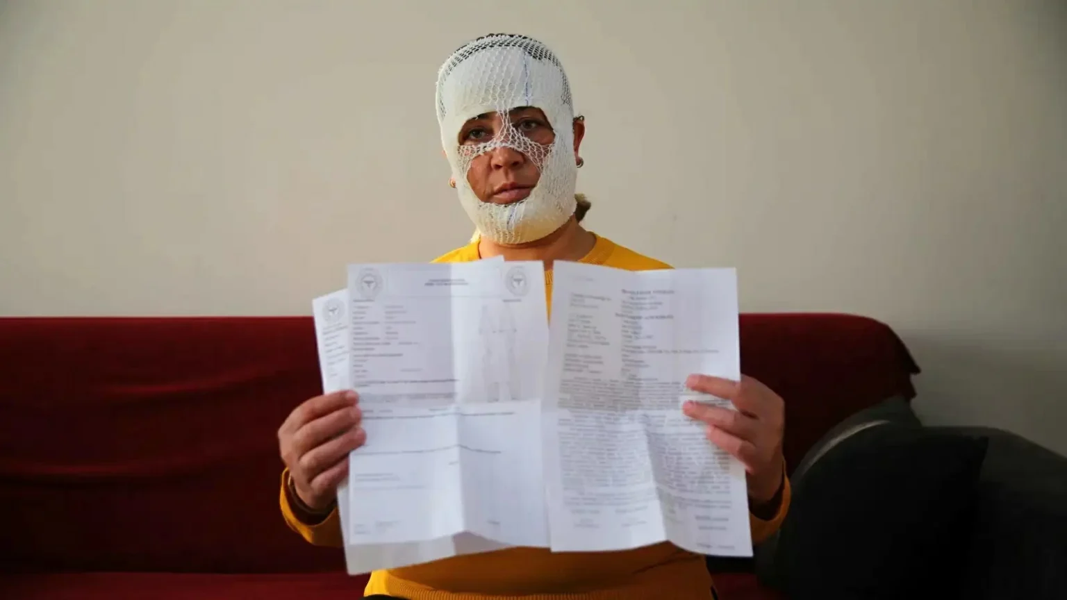 هرب منها ابنها.. «وجه الأميرة» يحترق في مركز تجميل تركي