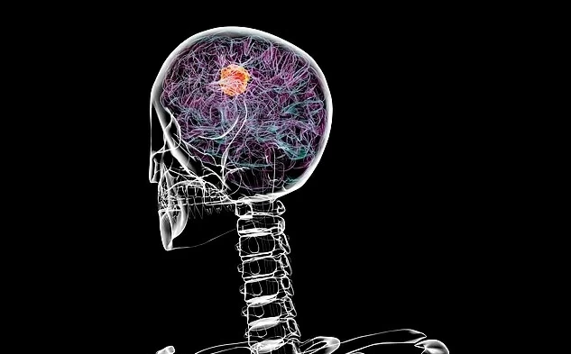 نتائج واعدة لعلاج CAR-T في القضاء على أورام الدماغ الخطيرة