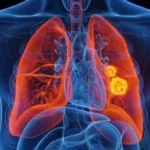 سرطان الرئة لغزٌ مختلف.. لماذا يصاب غير المدخنين أيضًا؟